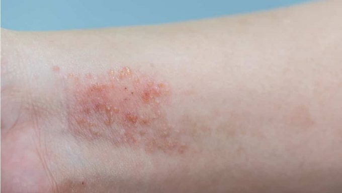 Dermatite Atópica | Jornal da Orla