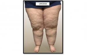 Confundido com obesidade, lipedema afeta 5 milhões de brasileiras