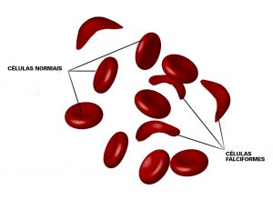 Ação orienta sobre anemia falciforme