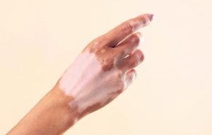 Pessoas com vitiligo sofrem preconceito