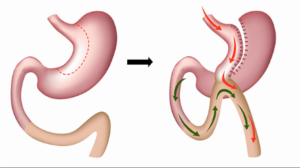 Conheça os principais tipos de cirurgia bariátrica