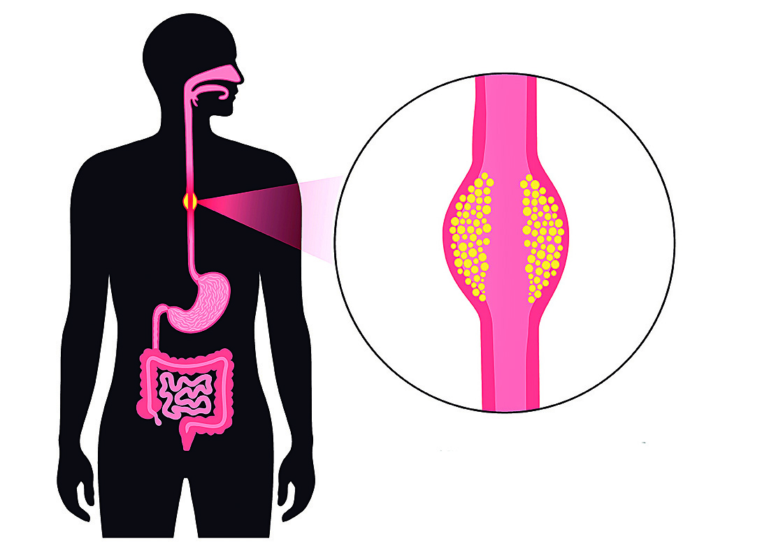 Sensação de comida presa na garganta pode ser câncer de esôfago | Jornal da Orla