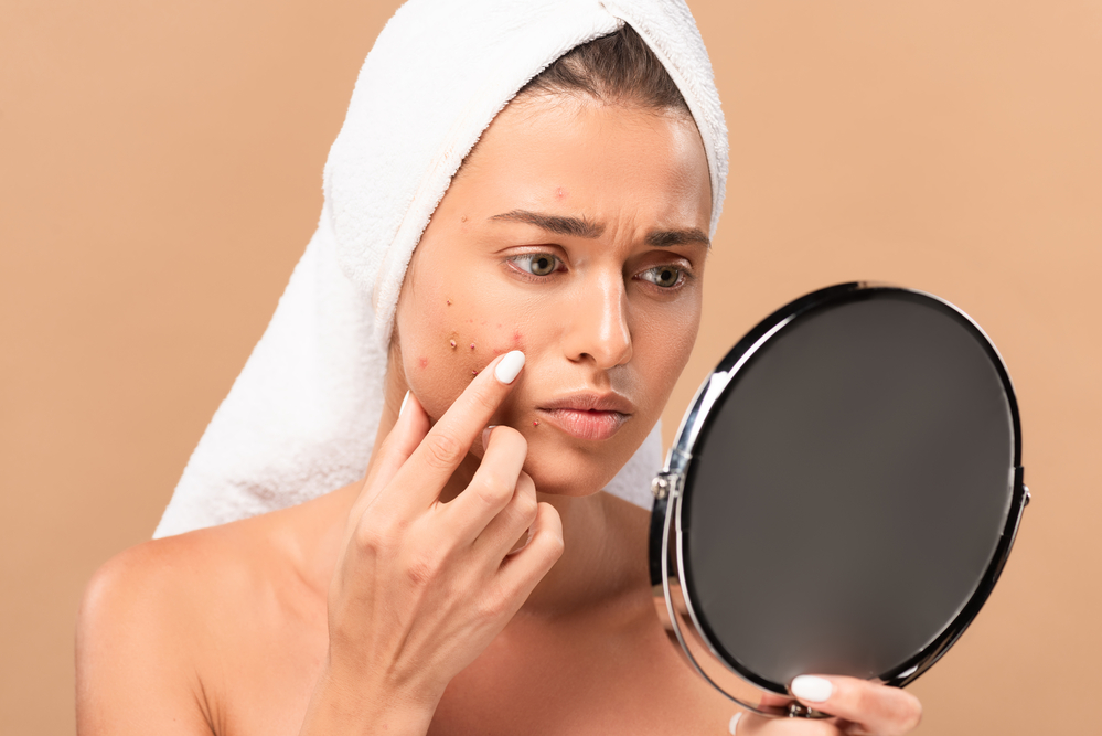 Cicatriz de acne e a técnica CROSS | Jornal da Orla