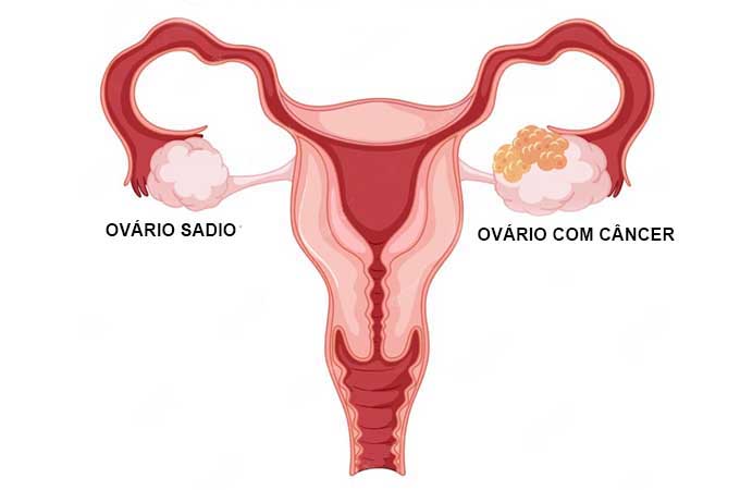 câncer de ovário sintomas