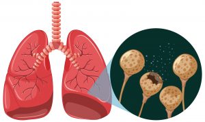 Tuberculose: saiba como identificar e tratar a doença