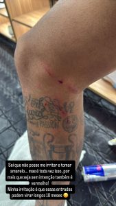 Neymar publica foto da perna machucada e ironiza arbitragem: ‘Podem virar longos 10 meses’