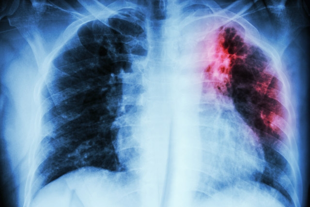 Hoje é o dia mundial de combate à tuberculose | Jornal da Orla