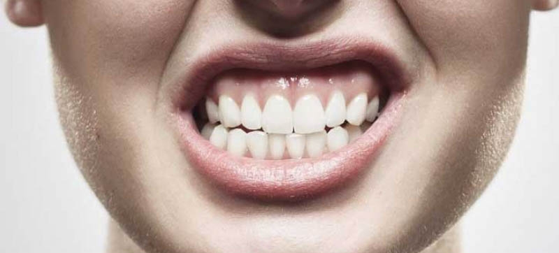 Bruxismo pode causar fratura do dente | Jornal da Orla