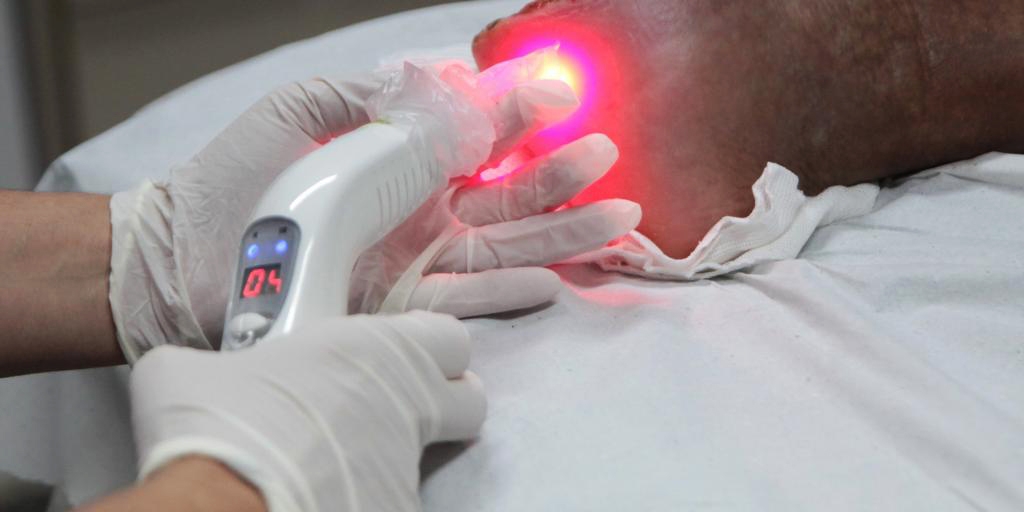 Tratamento de feridas com laser será ampliado para 20 unidades de saúde em Santos | Jornal da Orla