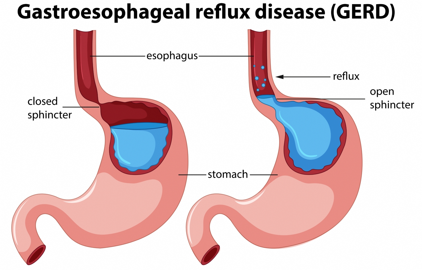 Doença do refluxo gastro esofágico | Jornal da Orla